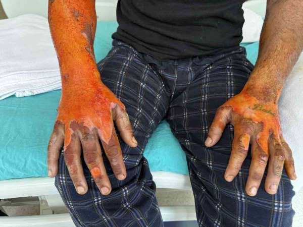 Akü patlaması, vücudunun yüzde 25'i yandı: 'Bomba gibi patlamalar, kendimi zor kurtardım'