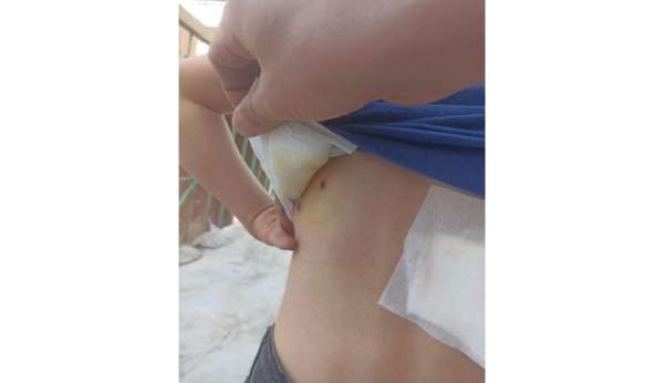 Diyarbakır'da 8 yaşındaki çocuk sokak köpeklerinin saldırısında yaralandı
