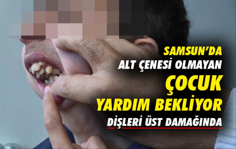 Alt çenesi yok, dişleri üst damağında: Ameliyat için yardım bekliyor