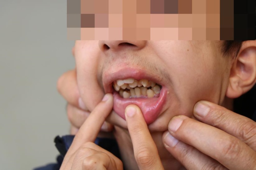 Alt çenesi yok, dişleri üst damağında: Ameliyat için yardım bekliyor