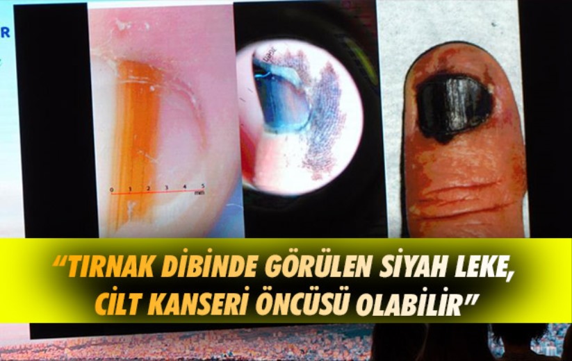 Tırnak Dibinde Görülen Siyah Leke Cilt Kanseri öncüsü Olabilir Samsun Son Haber Samsun 5877