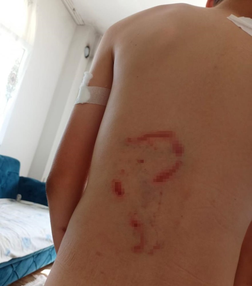 Samsun'da köpek saldırısında Yunus'un kolu kullanılamaz hale geldi, aile adalet arıyor