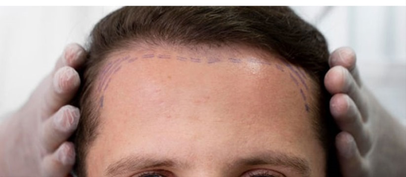 Antalya'da Saç Estetiğine İlgi Artıyor