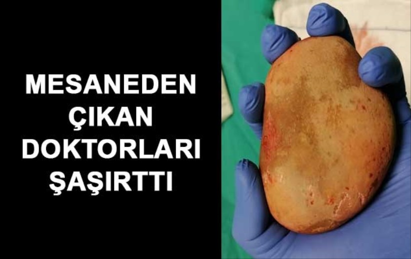 Mesaneden çıkan taş doktorları şaşırttı