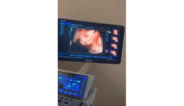Sinop Atatürk Devlet Hastanesi'ne 4 boyutlu ultrason cihazı