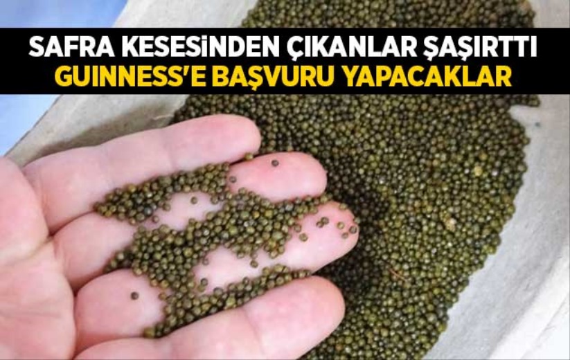 Safra kesesinden çıkanlar şaşırttı, Guinness'e başvuru yapacaklar