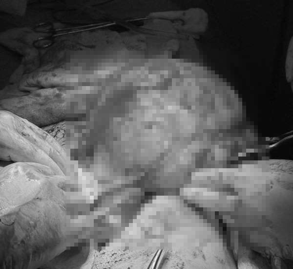 Karın ağrısı şikayetiyle gittiği hastanede karnından 30 santimlik dev kitle çıkarıldı