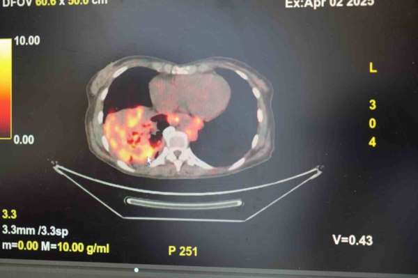 'Sigarasız akciğer kanseri' vakalarında dikkat çeken artış